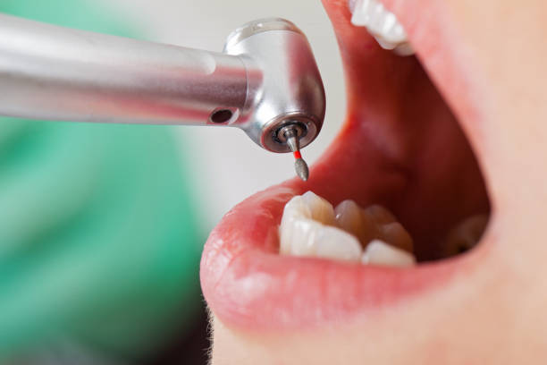 Best Emergency Treatment for Dental Infections or Abscesses in Key Largo, FL